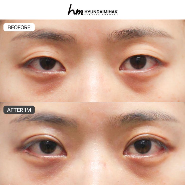Phẫu thuật chỉnh hình đôi mắt: thay đổi để có ánh mắt tự nhiên và rõ nét