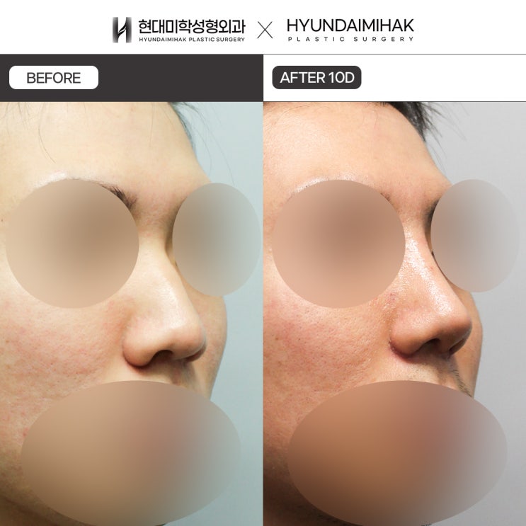 Tìm hiểu nhiều trường hợp tại bệnh viện nâng mũi nam
