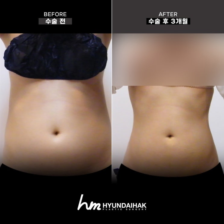 Chi phí tạo hình bụng hợp lý, được chứng minh bằng kết quả tại phòng khám thẩm mỹ khu vực ga Sinsa