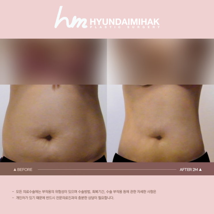 Hút mỡ Sinsa, chỉnh gọn cả phần mỡ đùi trong
