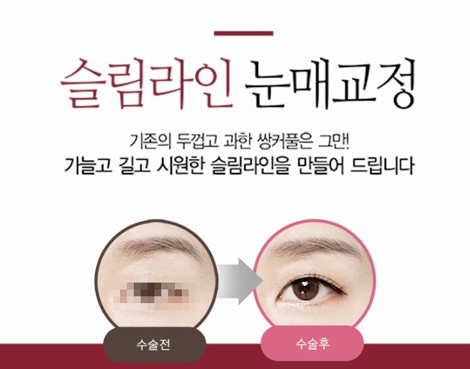 Chỉnh hình cơ nâng mi bằng đường rạch: sự tự tin có lý do