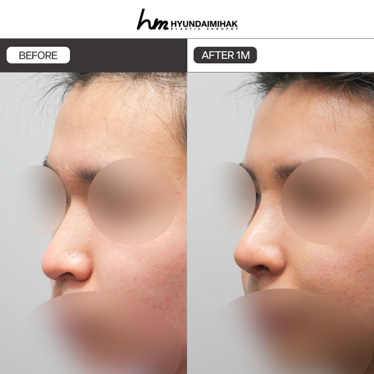 Cách nâng mũi thấp cho nam một cách tự nhiên