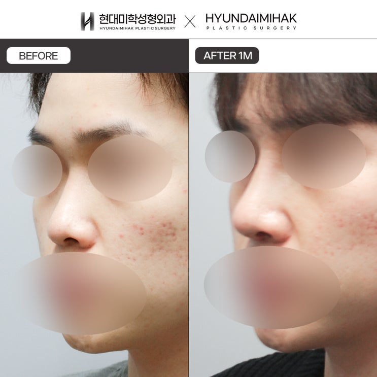 Làm thế nào để phẫu thuật mũi nam tự nhiên