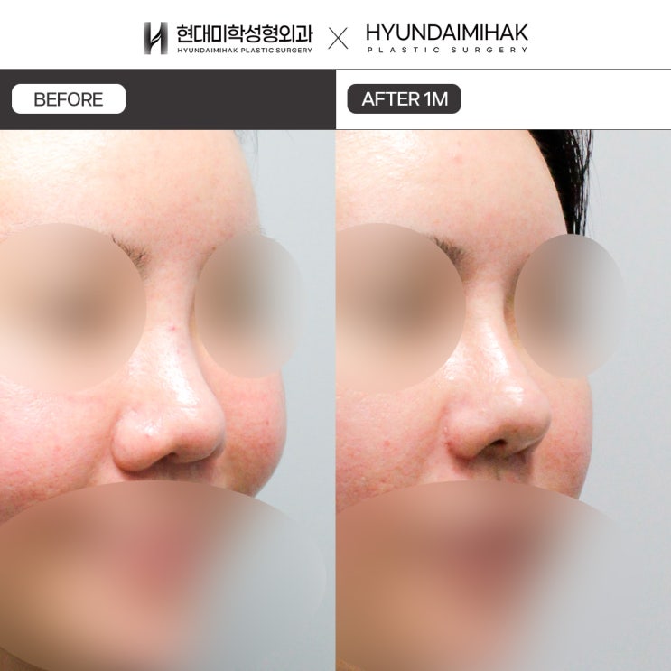 Trước và sau phẫu thuật mũi đầu tròn: cách thay đổi để có đầu mũi thanh thoát và mềm mại hơn