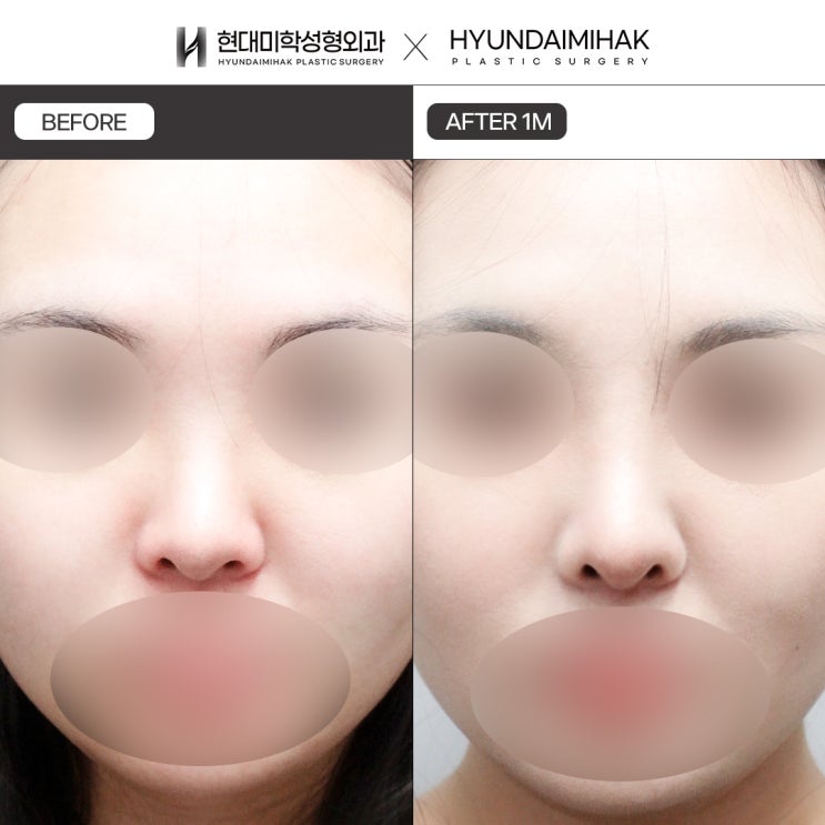Giúp đường nét vách ngăn mũi ngắn trở nên nổi khối hơn