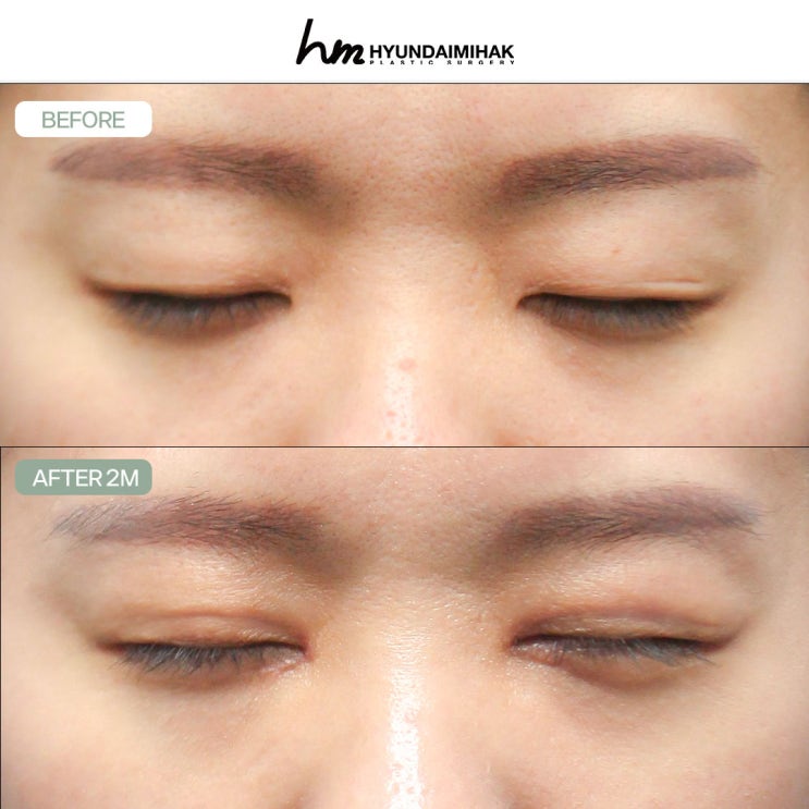 Chỉnh sửa mắt sụp｜Phẫu thuật tinh tế giúp đôi mắt rõ nét hơn và thay đổi ấn tượng khuôn mặt