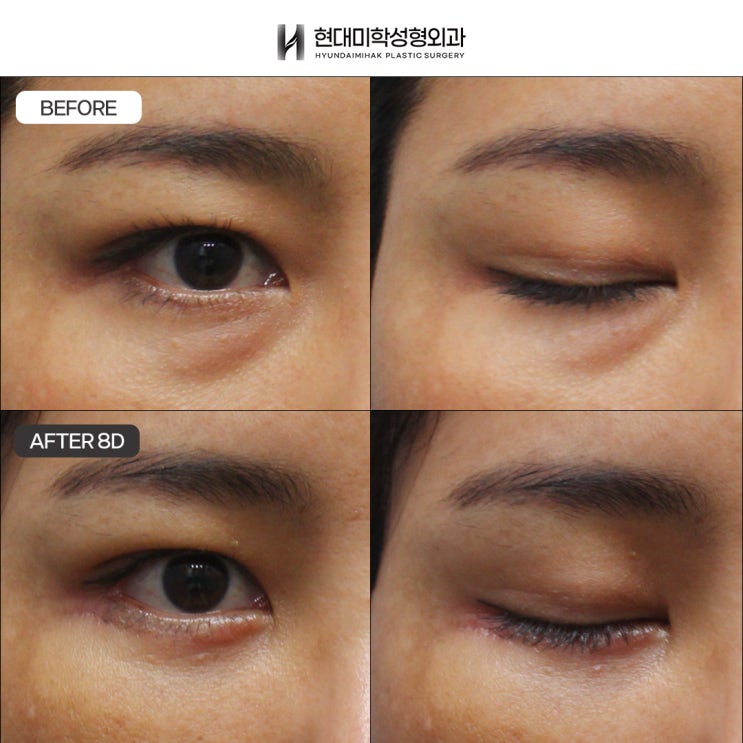 Bệnh viện tái sắp xếp mỡ dưới mắt cho đôi mắt trẻ trung và đầy sức sống