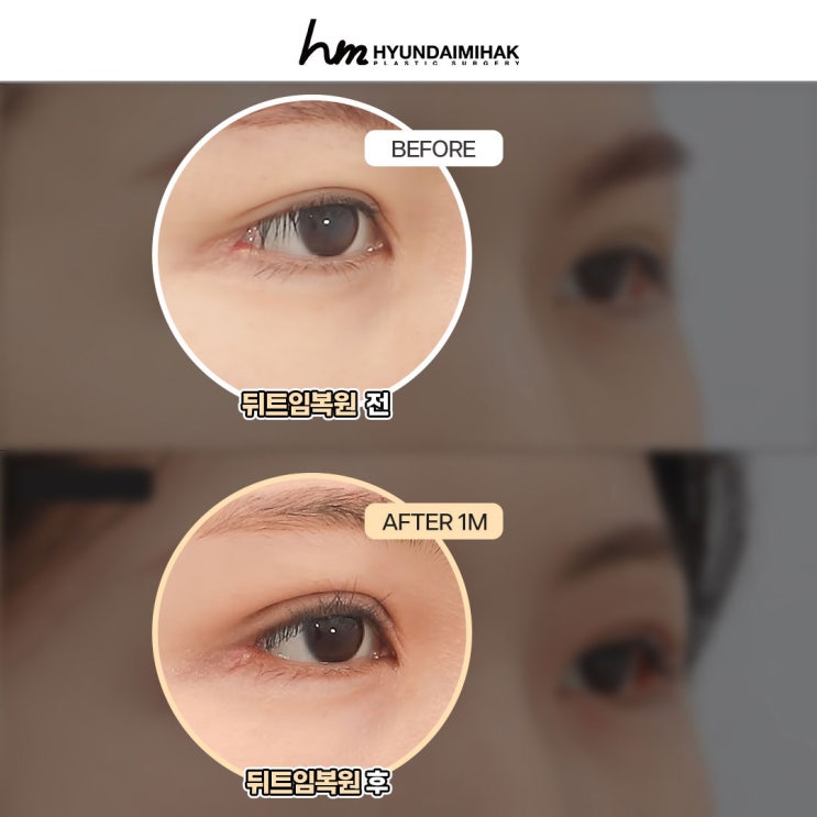 Phục hồi mở rộng đuôi mắt để lấy lại dáng mắt tự nhiên
