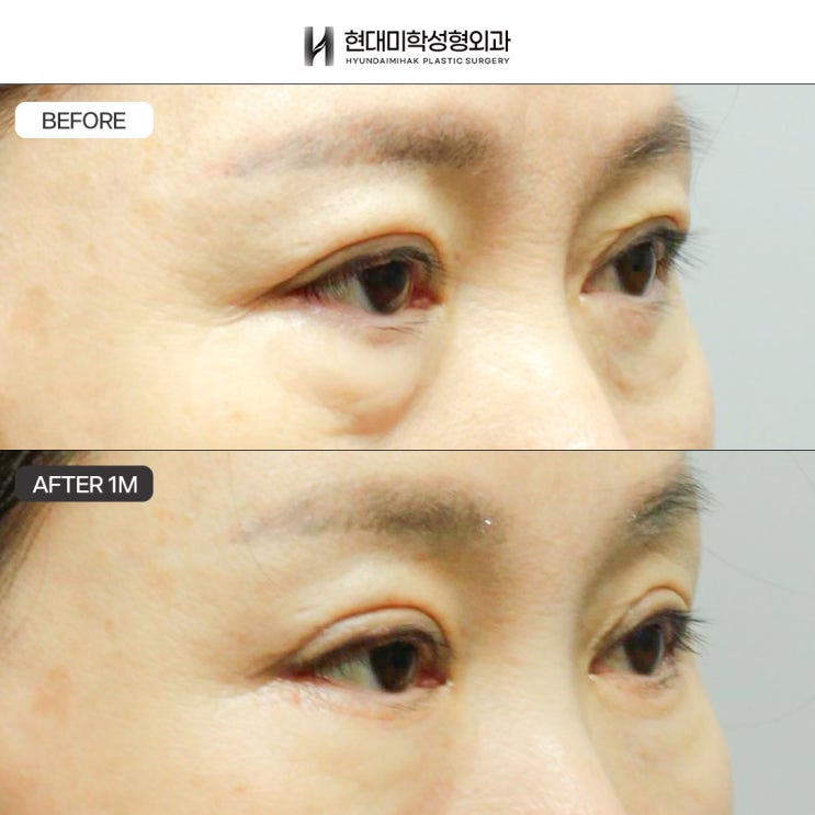 Phẫu thuật mí dưới tuổi trung niên cho mỡ bọng mắt dày