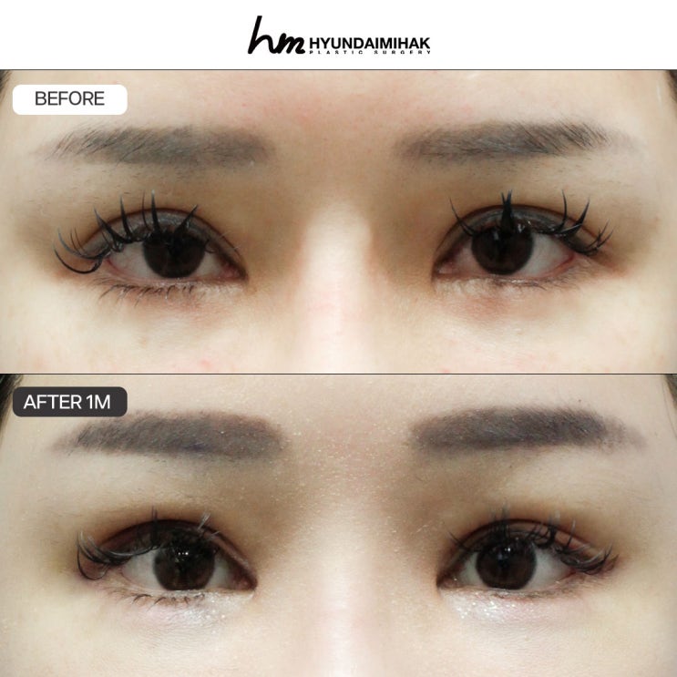 Review chỉnh hình mắt: nhanh chóng thoát khỏi vẻ ngoài buồn ngủ