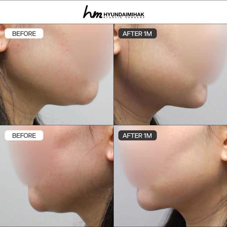 Hút mỡ nọng cằm: Đừng trì hoãn vẻ đẹp của mình