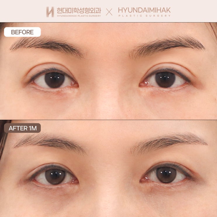 Hạ đường nếp mí bằng điều chỉnh đường mí để đôi mắt trông tự nhiên hơn