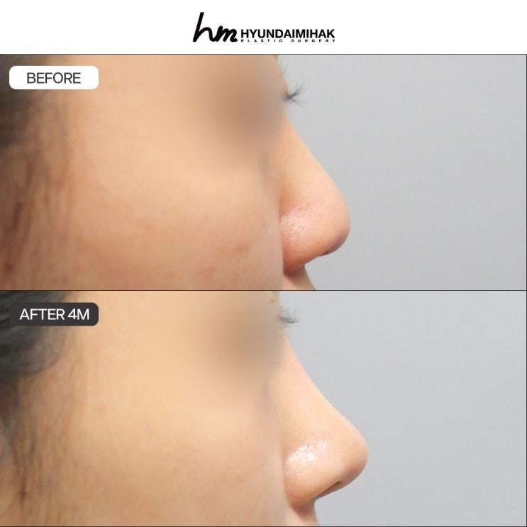 Các kiểu dáng mũi: thông tin cần kiểm tra trước khi phẫu thuật