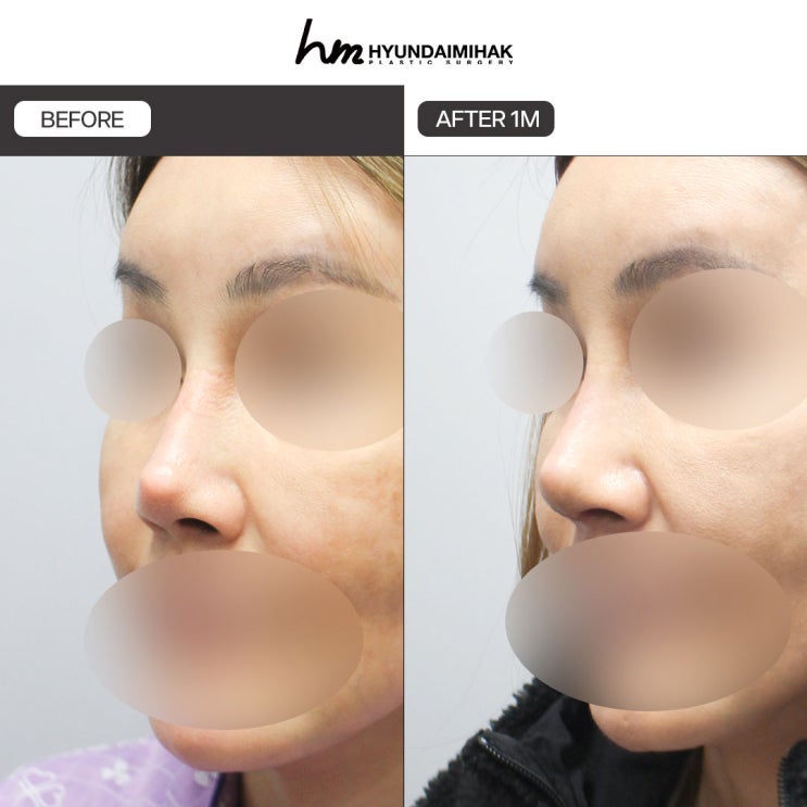 Vì sao chi phí phẫu thuật mũi lệch lại khác nhau rất nhiều ở mỗi người