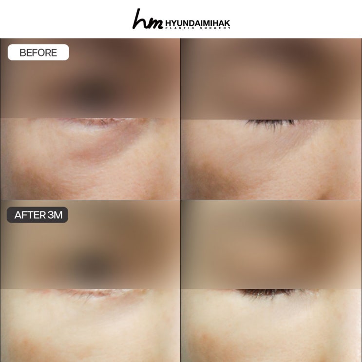Chi phí phẫu thuật mí dưới: tiêu chí chọn bệnh viện giàu kinh nghiệm