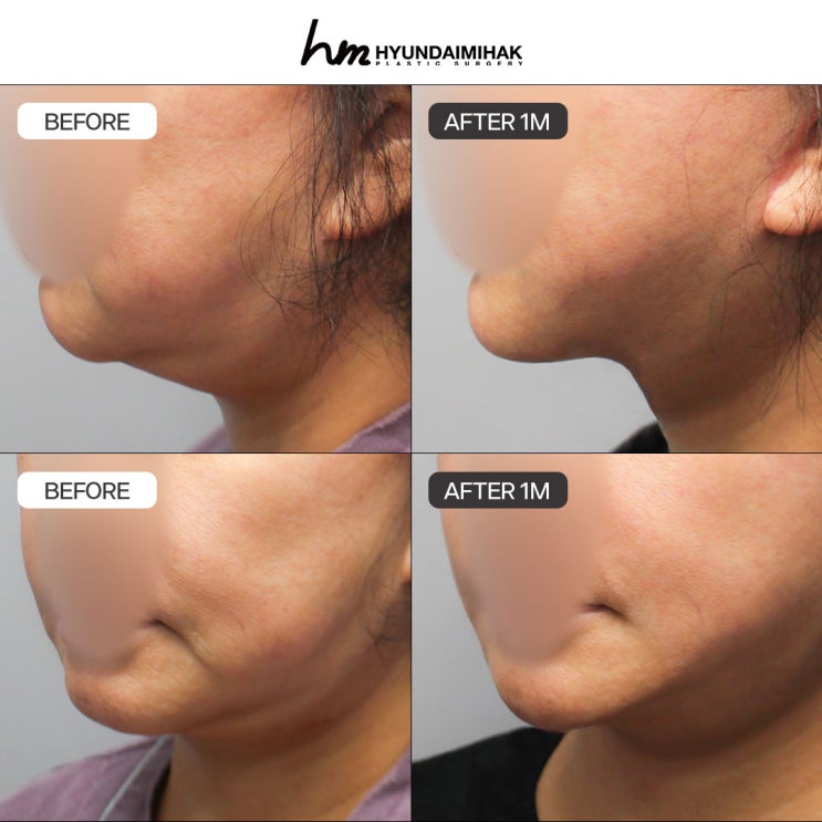 Căng chỉ ở tuổi 50: Đã đến lúc bắt đầu liệu trình nâng cơ thay đổi diện mạo