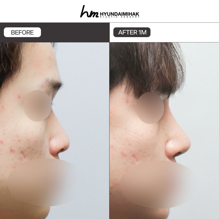 Phẫu thuật mũi nam khác biệt ở điểm nào và nên lựa chọn ra sao?