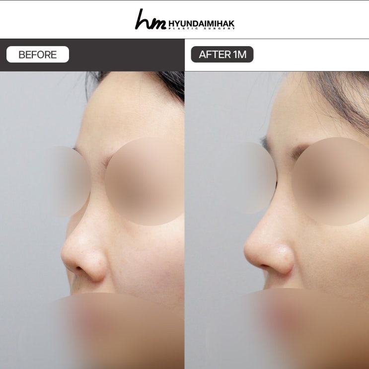 Phẫu thuật chỉnh mũi hếch: Cách tạo ấn tượng thanh lịch và có chiều sâu