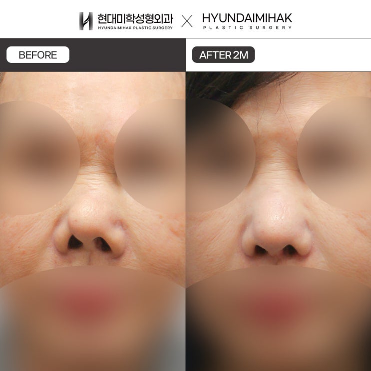 Lựa chọn nơi phù hợp để tái tạo mũi co rút