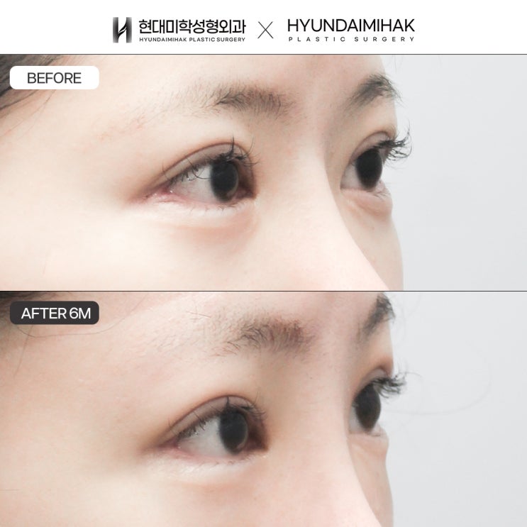 Phục hồi mở rộng đuôi mắt an toàn và mang lại kết quả hài lòng