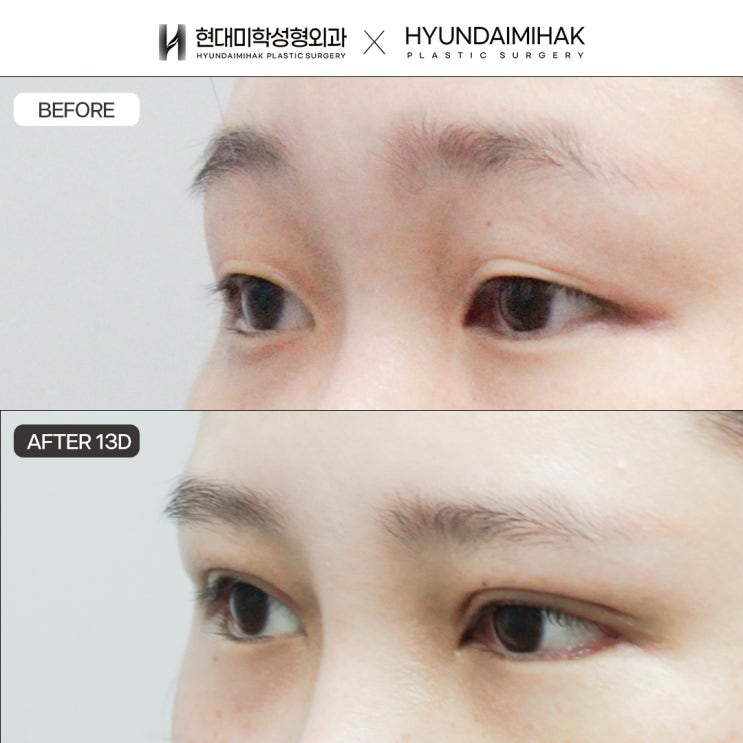 Trước và sau chỉnh hình mắt bằng đường rạch: sự thay đổi đôi mắt rõ nét và tự nhiên