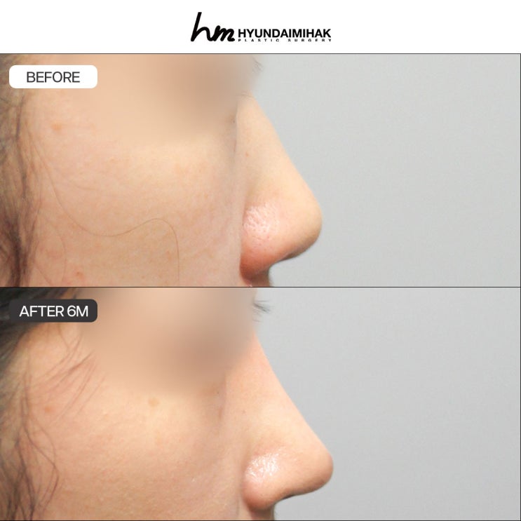 Sụn sườn hiến tặng: giải pháp nâng mũi tái phẫu thuật ít gánh nặng