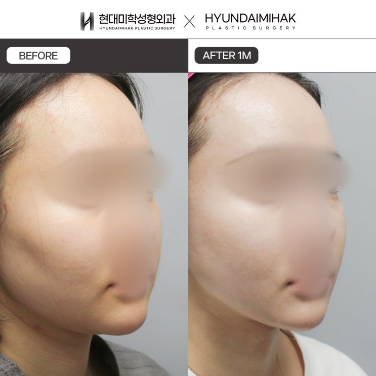 Phẫu thuật giảm mỡ mặt: làm sao để tránh chảy xệ và lõm hóp