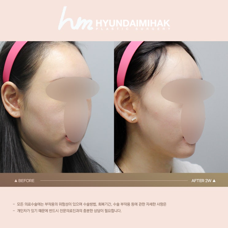 Khi mỡ nọng cằm chảy xệ không cải thiện dù đã ăn kiêng, giải pháp là gì?