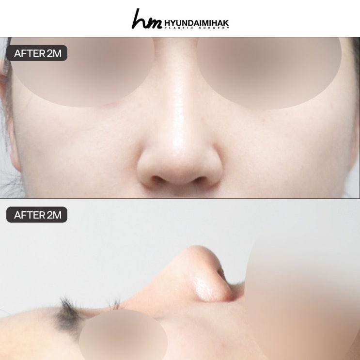 Nâng mũi tự nhiên sắc nét: giải pháp cân bằng giữa vẻ tự nhiên và đường nét rõ ràng
