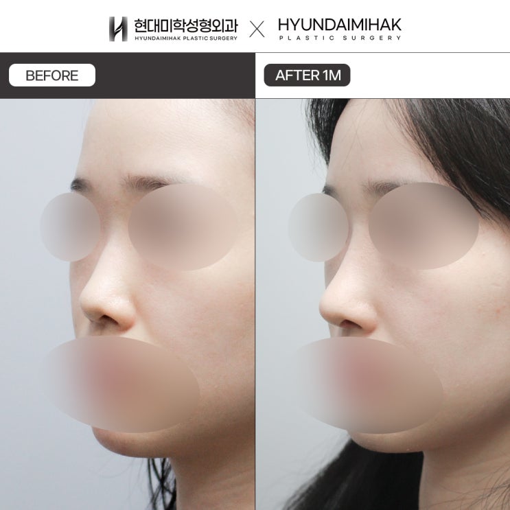 Phẫu thuật mũi thấp tạo sự hài hòa giữa sống mũi và đầu mũi