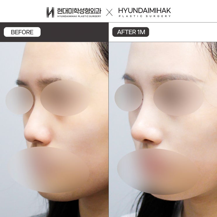 Trước và sau nâng mũi kín: sẹo không nhìn thấy