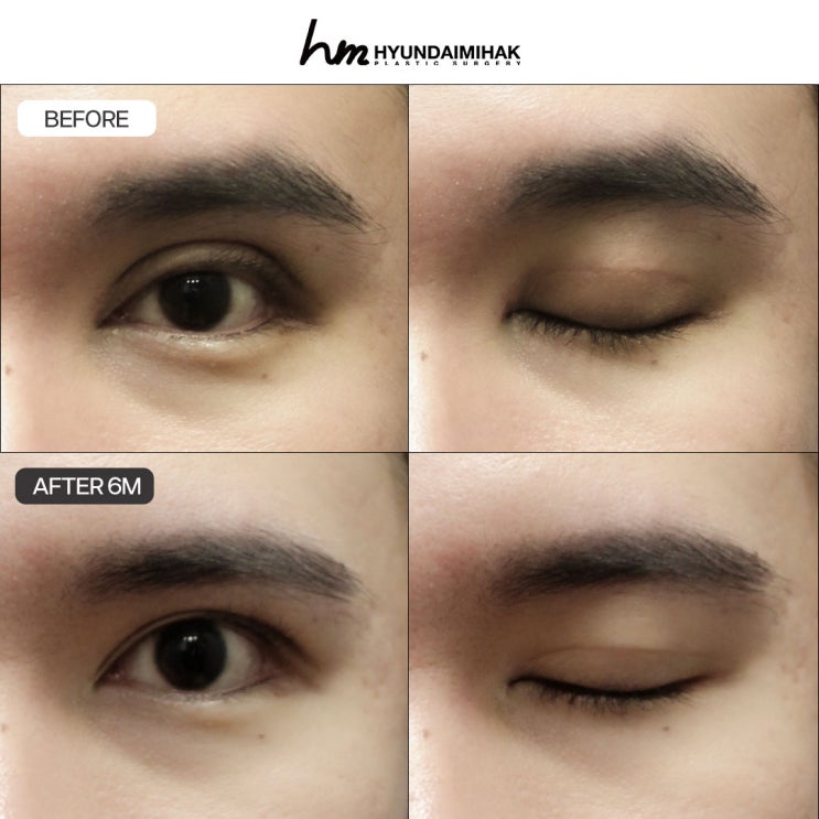 Hãy chọn bệnh viện phẫu thuật chỉnh sửa mắt khó, không để xảy ra thất bại