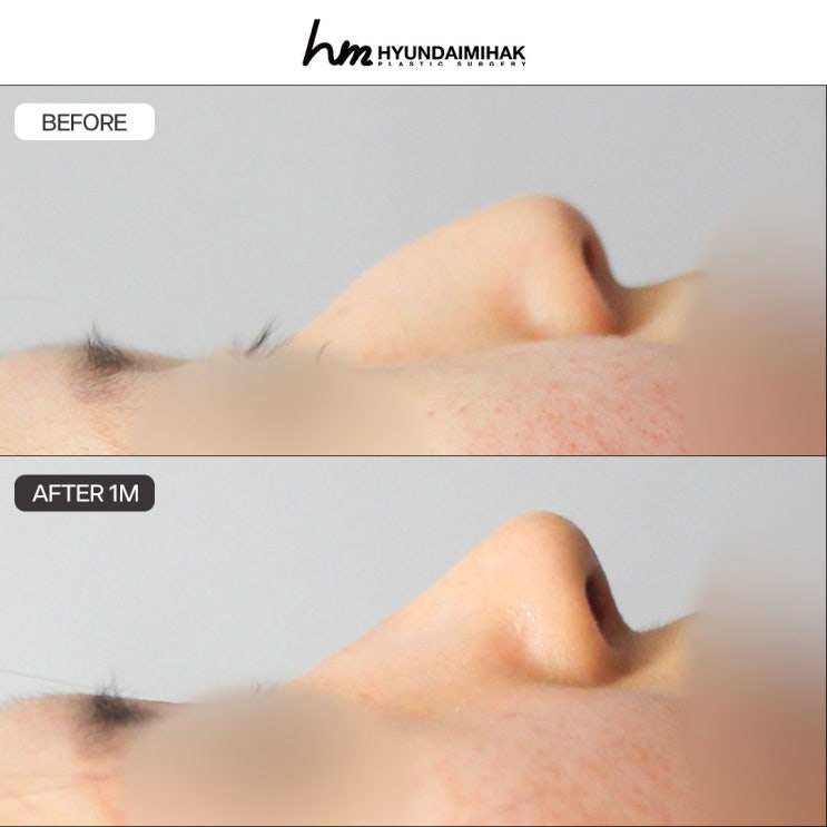 Bệnh viện phẫu thuật mũi gồ giỏi: đã đến lúc thay đổi ngay hôm nay