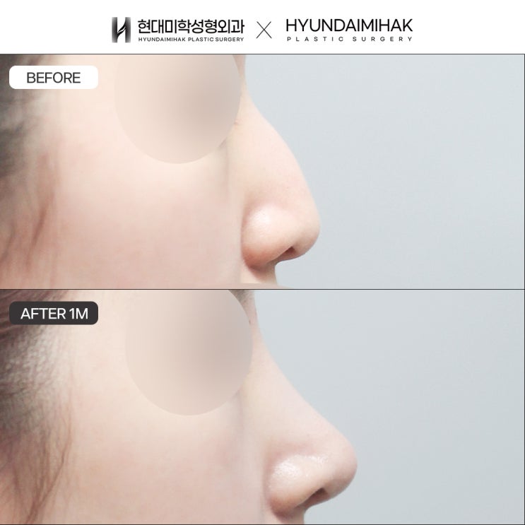 Mũi gồ ở nữ: Các dạng gồ sống mũi đa dạng hơn bạn nghĩ