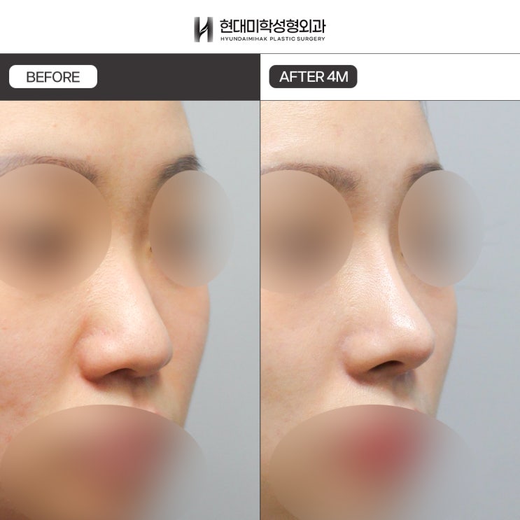 Nâng mũi dáng thẳng cong nhẹ, chỉnh sửa mũi thấp để có sự thay đổi tự nhiên và tinh tế