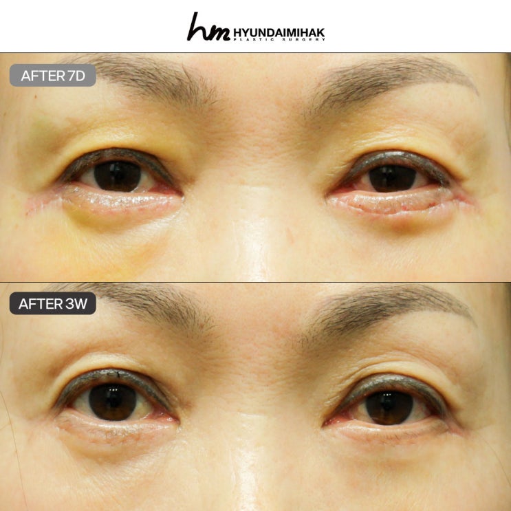 Nếu bạn muốn kết quả tự nhiên, không để lại sẹo sau phẫu thuật mí dưới