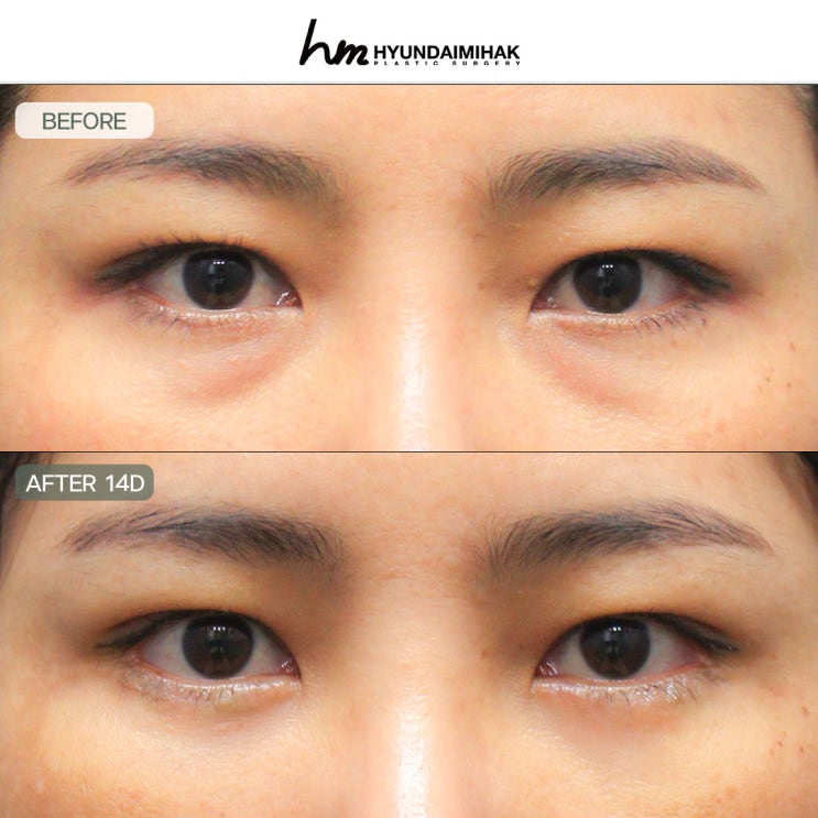 Nhất định phải đọc trước khi tư vấn tại bệnh viện điều trị bọng mắt: trẻ hơn mà không gặp tác dụng phụ