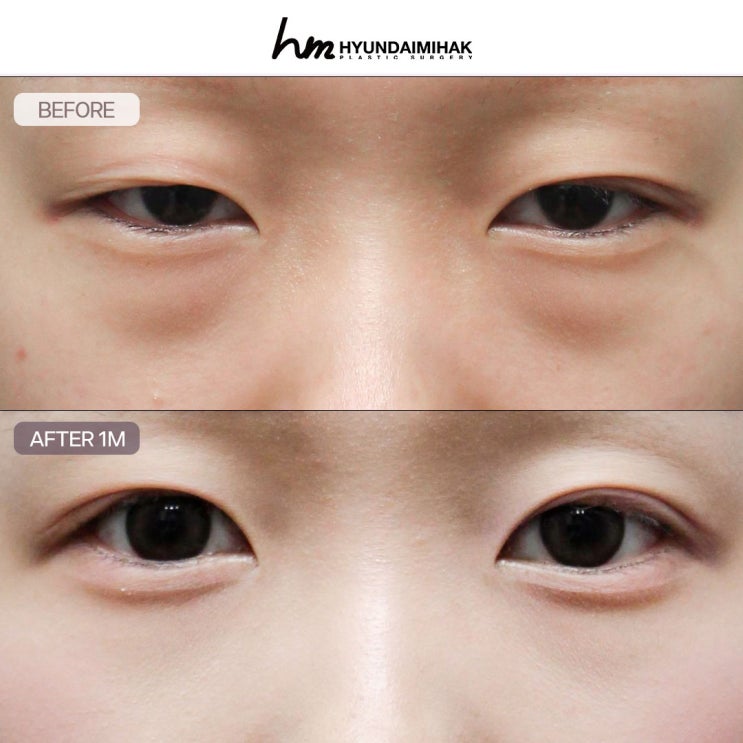 Trước và sau tái định vị mỡ dưới mắt: gương mặt trẻ hơn, hồi phục nhanh hơn