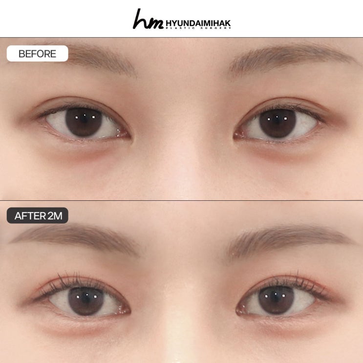 Chi phí phục hồi khóe mắt trong: Nếu muốn một ca phẫu thuật không hối tiếc