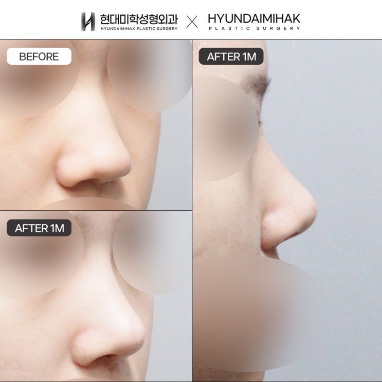 Nâng mũi sụn sườn tự thân: lựa chọn mới để cải thiện dáng mũi tự nhiên