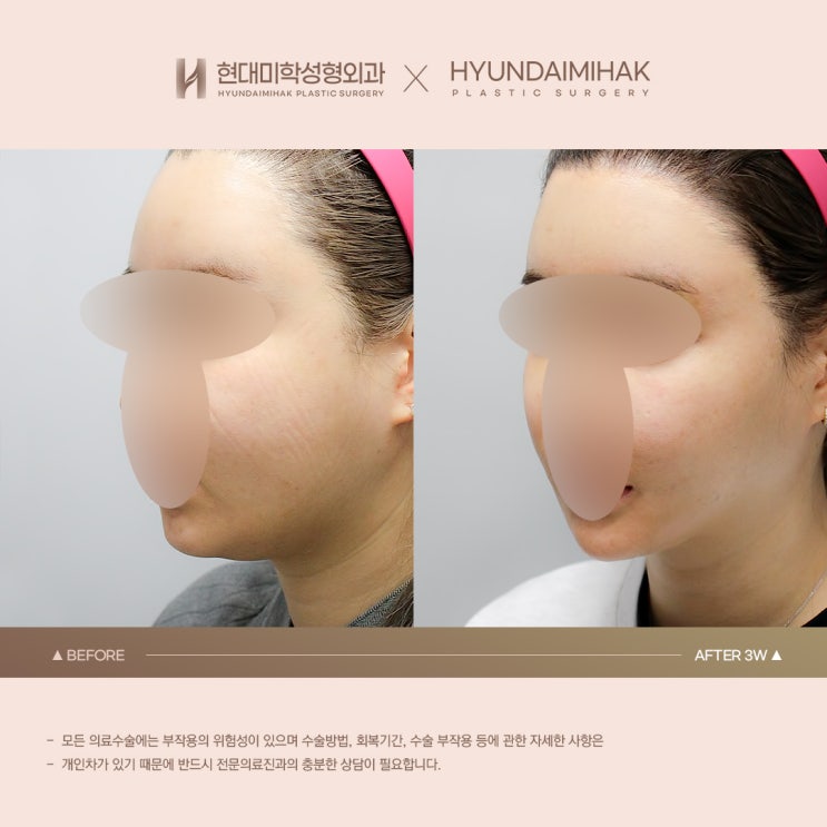 Hiệu quả chỉnh gọn đường nét khuôn mặt qua hình ảnh trước và sau hút mỡ nọng cằm