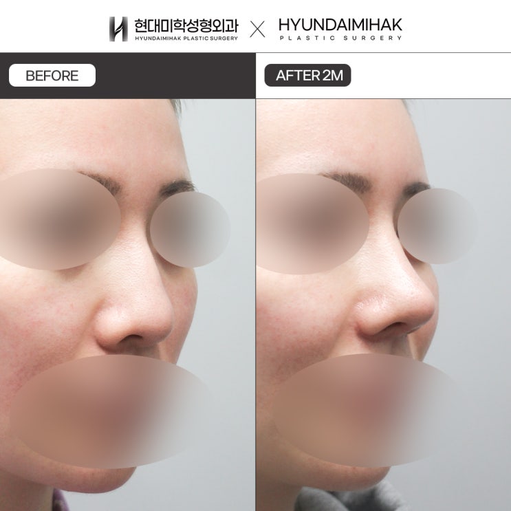 So sánh sự khác biệt về giá phẫu thuật nâng mũi thấp