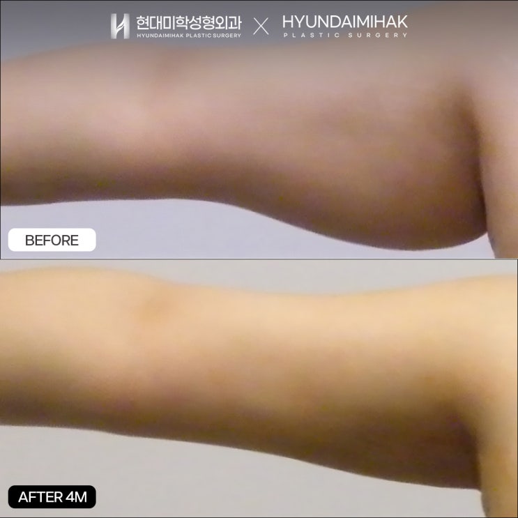 Làm sao để đạt hiệu quả với mức giá hút mỡ hợp lý