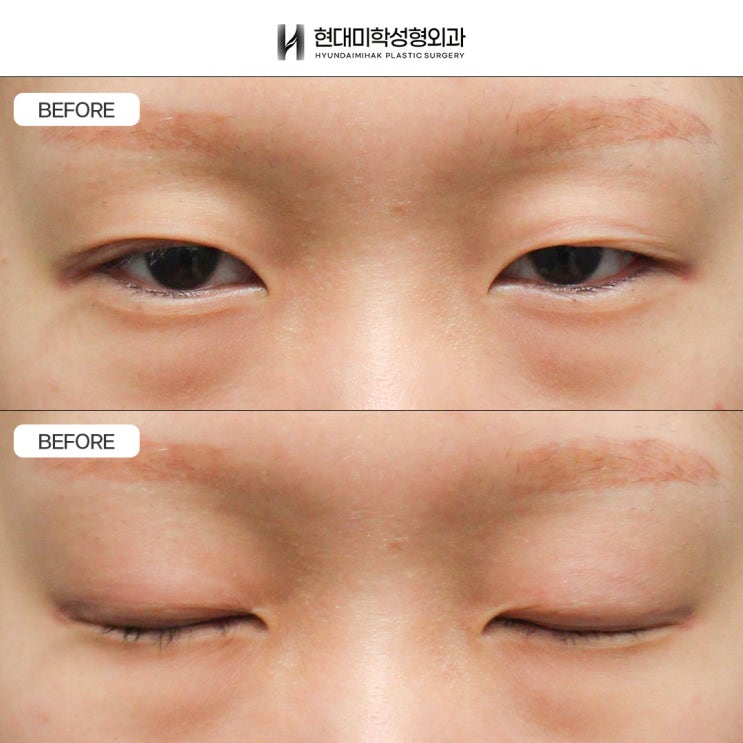 Bệnh viện chỉnh cơ nâng mi giỏi: Cải thiện đôi mắt sụp mí như thế nào