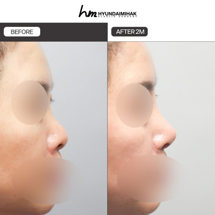 Thay đổi ấn tượng chỉ bằng một khác biệt tinh tế với phẫu thuật thu gọn cánh mũi