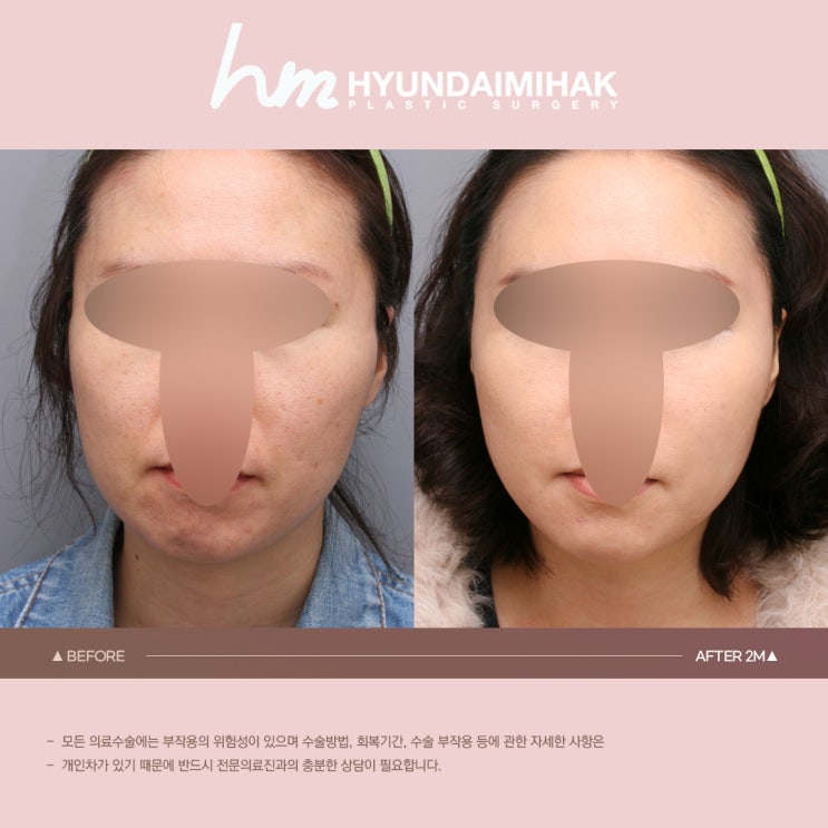 Nâng cơ tuổi trung niên: Giữ gìn nét trẻ trung ngay cả sau tuổi 50