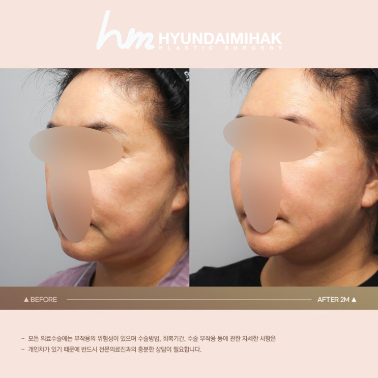 Nâng cơ ở tuổi 40: nắm bắt thời điểm để lấy lại nét trẻ trung