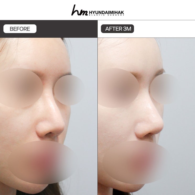 Cách lựa chọn thông minh khi xem xét cả chi phí phẫu thuật nâng sống mũi và di chứng