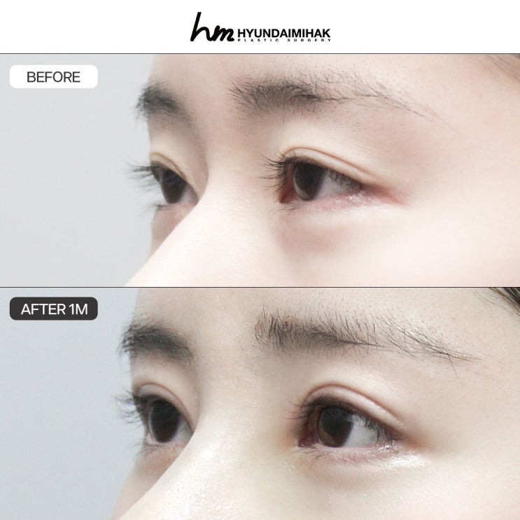 Tổng hợp hiệu quả trước sau và quá trình hồi phục sau mở rộng đuôi mắt