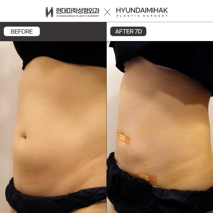 Chi phí hút mỡ mini: Lựa chọn thông minh cho vóc dáng cân đối